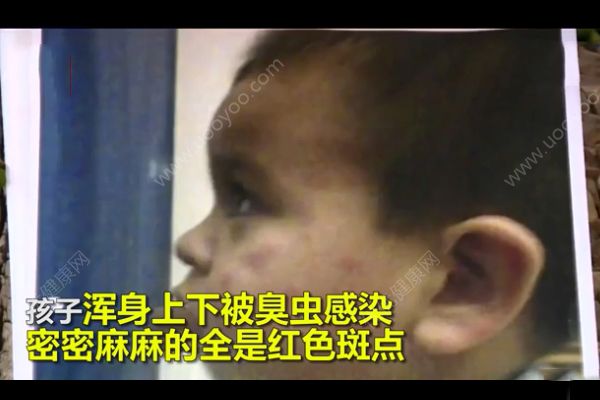 幼兒遭臭蟲咬傷獲賠1000萬！遭到蟲子咬怎么急救？(4)