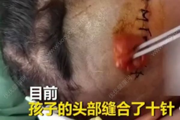 3歲男孩小區(qū)內(nèi)被狗咬頭縫10針，被狗咬傷后怎么處理？(4)