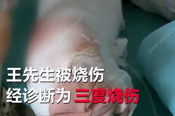 不慎引燃酒精桶，男子家中吃燒烤吃成三度燒傷(1)