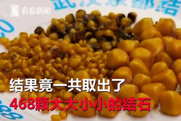 愛吃油炸長468顆結石，油炸食品的危害有哪些？(1)