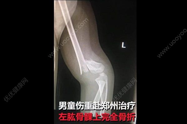 男童被踹下滑梯胳膊折成三截，肇事方家長(zhǎng)抱娃就溜(2)