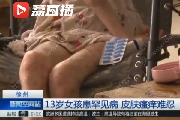 女孩患罕見病最怕熱，家貧買不起空調只靠奶奶背起來回走(3)