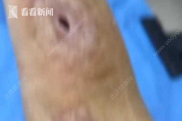 男子殺魚時(shí)不小心劃傷手指，幾個(gè)月后右手手臂被