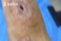 男子殺魚時不小心劃傷手指，幾個月后右手手臂被"蛀空"[多圖]