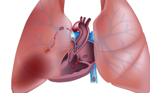 肺栓塞的癥狀有哪些？肺栓塞的臨床表現(xiàn)是什么？(1)