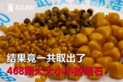 愛吃油炸長468顆結(jié)石，油炸食品的危害有哪些？[多圖]