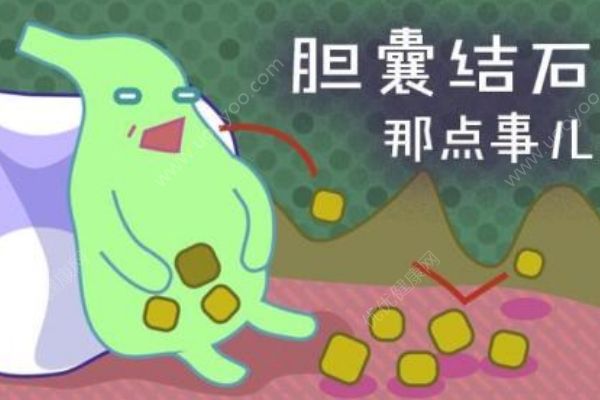 哪些人最容易得膽結(jié)石？膽結(jié)石有哪些明顯特征？(1)