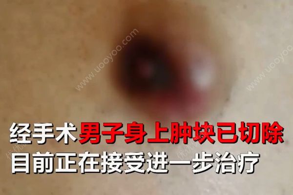 六旬老翁患上女人病！醫生說乳腺癌非女性專利！(4)