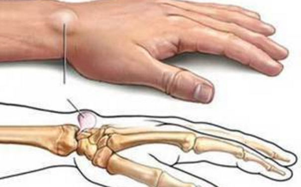 手腕起了一個鼓包怎么回事？手腕鼓包是什么原因？(1)