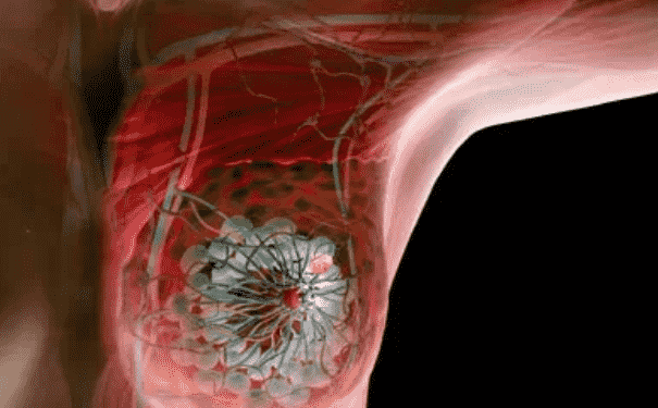 乳腺癌的早期信號是什么？誘發乳腺疾病的原因是什么？(1)