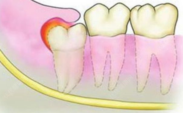 智齒發炎應該怎么辦？智齒很疼該不該拔掉？(2)