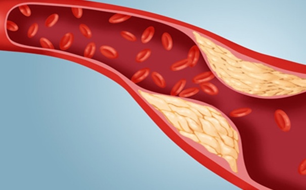 動脈粥樣硬化有哪些危害？動脈粥樣硬化怎么調理？(1)