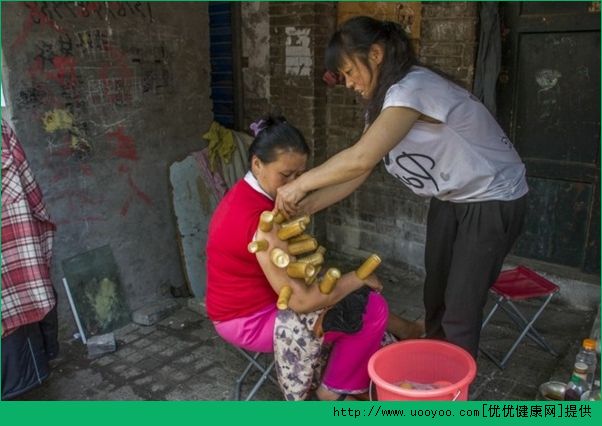 拔火罐有什么作用？拔罐的好處有哪些？(3)