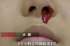 一學(xué)習(xí)就流鼻血！12歲男孩一天流20多次無奈休學(xué)！[多圖]