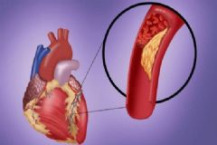 動脈硬化有何癥狀？動脈硬化如何診斷？[圖]