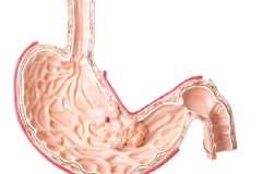 哪些習(xí)慣容易患胃癌？哪些人容易患胃癌？[圖]