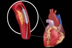 心臟病人要如何護(hù)理？心臟病有哪些危害？[圖]