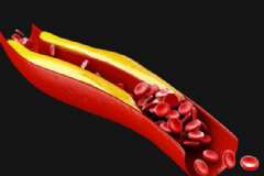 如何預防血管堵塞？怎么樣預防血管堵塞？[圖]