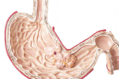 胃癌早期的癥狀有哪些？如何及時(shí)發(fā)現(xiàn)胃癌征兆？[圖]