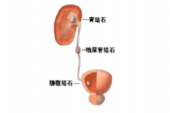 膀胱結石手術治療會有效嗎？膀胱結石手術治療的效果[圖]