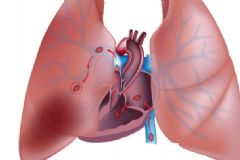 肺栓塞的癥狀有哪些？肺栓塞的臨床表現是什么？[圖]