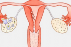 卵巢切除后怎么保養好？卵巢切除后怎么保養？[圖]