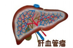 肝血管瘤嚴(yán)重嗎？肝血管瘤的癥狀表現(xiàn)[圖]