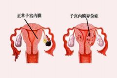 子宮內膜異位癥能自然懷孕嗎？子宮內膜異位癥為什么影響懷孕？[圖]