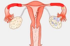輸卵管堵塞還能排卵嗎？輸卵管堵塞怎么辦？[多圖]