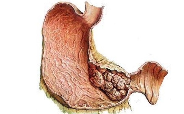 胃癌早期能治好嗎？胃癌早期有那些癥狀？(1)