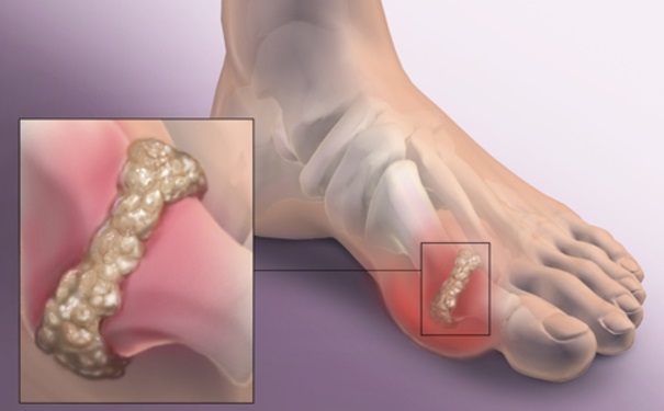 男性和女性發生痛風有什么區別？日常生活要怎樣預防痛風(1)