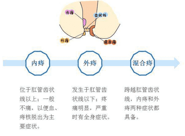 武漢江漢博仕醫院 痔瘺和痔瘡是一個病嗎