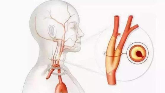 血管狹窄是什么意思？血管狹窄可以恢復嗎？