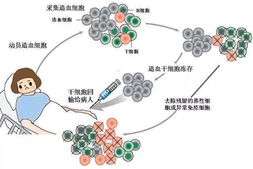 濟南血液病醫院：治療淋巴瘤自體造血干細胞移植效果咋樣？