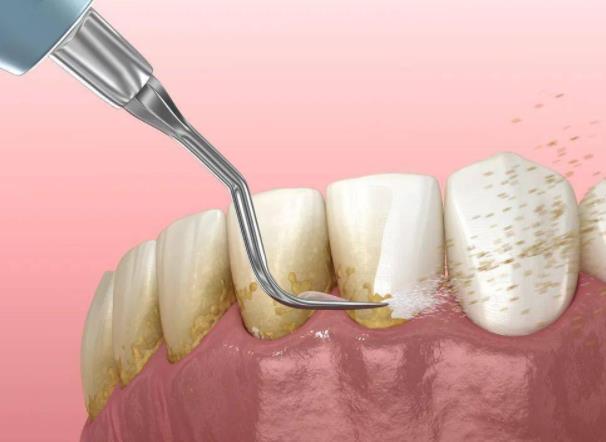 牙結石一次能完全洗干凈嗎？不想洗牙怎么去牙結石
