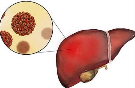 肝病怎么徹底治好？如何預防肝病