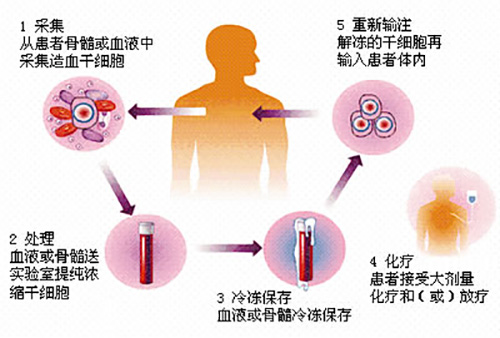 濟南血液病醫院科普：骨髓瘤患者自體移植前需要做好哪些準備？