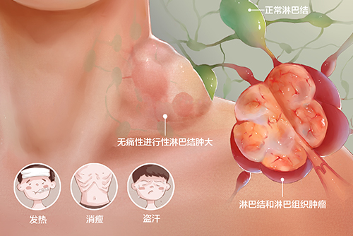 濟南血液病醫院科普：確診淋巴瘤該如何治療？自體移植效果好嗎？