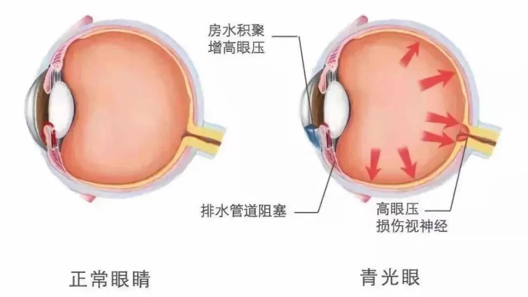 【合肥愛爾眼科】提醒：任何年齡都可能患上青光眼