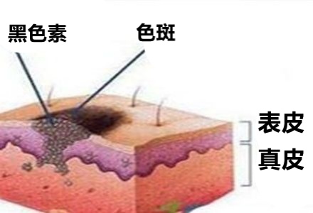 祛斑霜用出終生難愈皮炎，千金散去再也換不回一張健康臉！