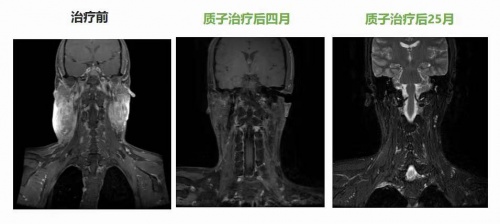 腫瘤放療“皇冠上的明珠”質子治療，竟比普通放療更“省錢”