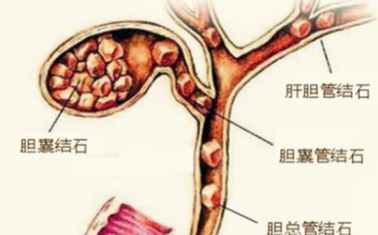 膽結石有什么癥狀 右上腹疼痛寒戰高熱惡心厭食