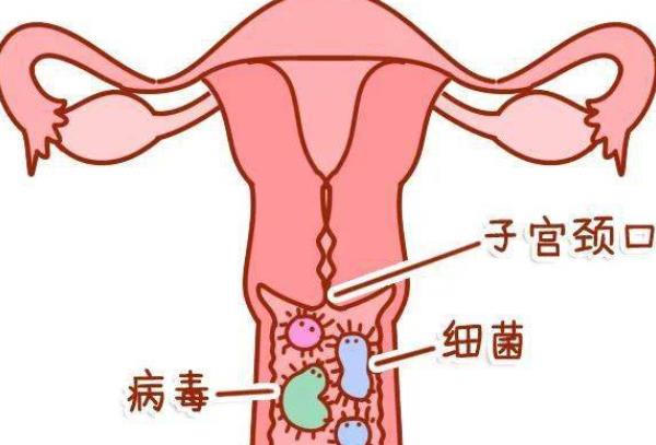 急性宮頸炎主要癥狀有哪些 白帶多呈膿性息肉下腹墜痛