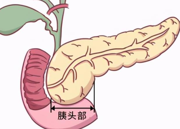 胰腺癌晚期能活多久 發病率低預后難3-6個月