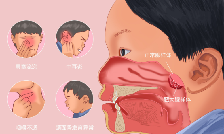 腺樣體肥大有什么影響？聽成都民生耳鼻喉醫院解答：腺樣體肥大的危害