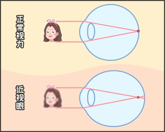 合肥愛爾：「我可以治好你的近視，但不改變度數。」啥？