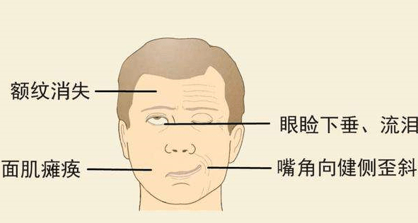 北京廣濟醫院怎么樣，治療面癱找對科室少走彎路