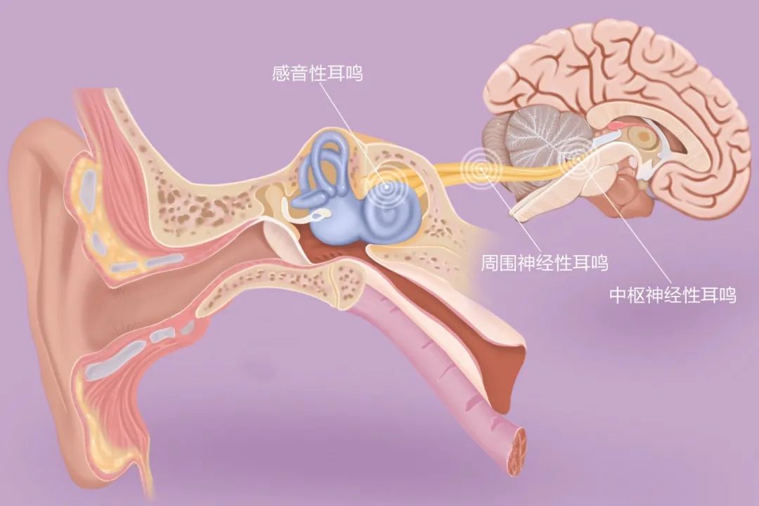 “嚶嚶嚶…”，成都民生耳鼻喉醫院提醒：耳鳴是身體的警報，須重視！