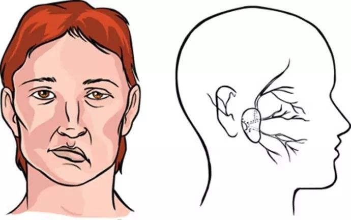 上海健橋醫院好不好，面癱的兩種常見癥狀和治療方法