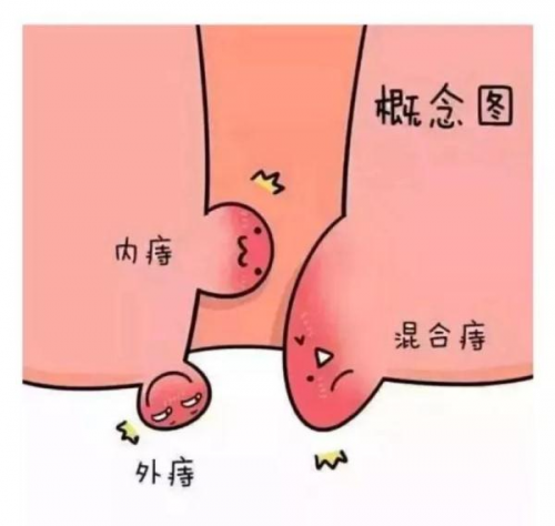 廣州東大肛門腸醫(yī)院怎么樣關(guān)于痔瘡治療的幾個(gè)誤區(qū)！